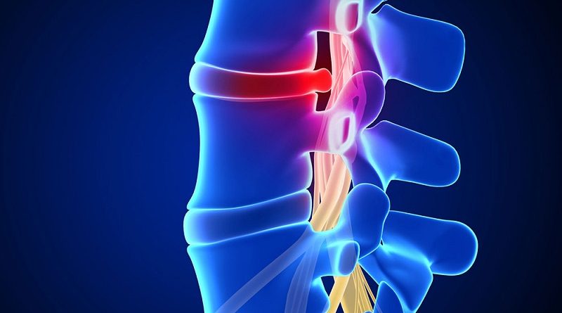 Лечение межпозвоночной грыжи