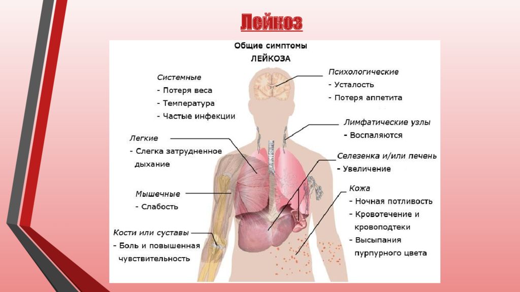 Как происходит лечение лейкоза в Израиле в частной клинике Ассута